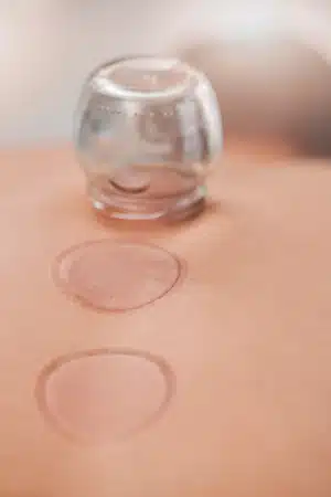 person receiving cupping treatment at wellness spa