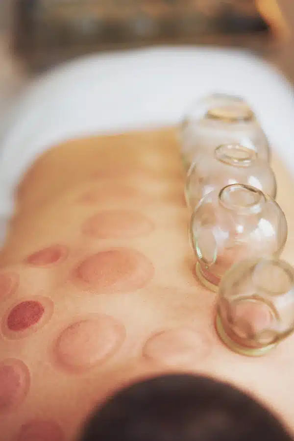 Cupping Therapy for sports injury treatment in burbank