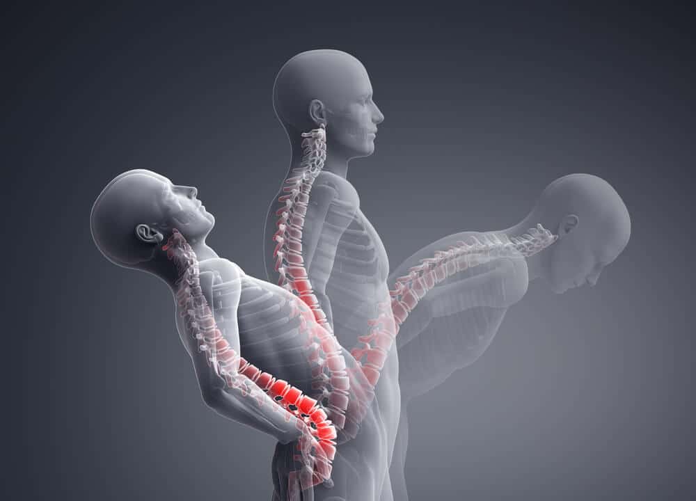 spinal misalignment